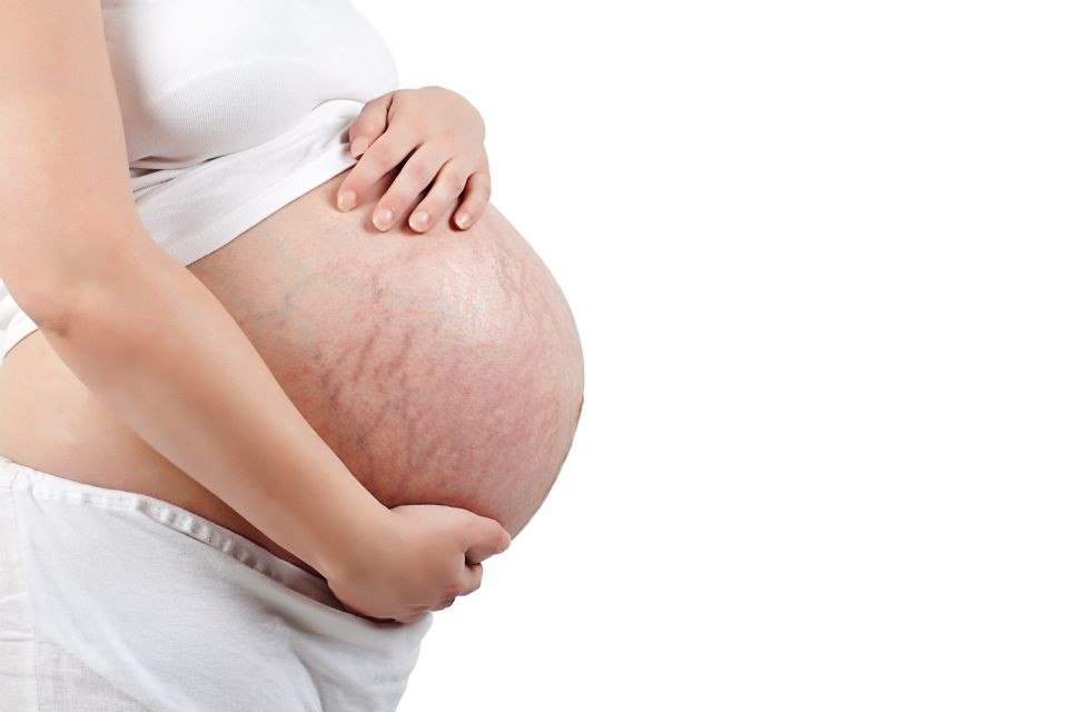 Растяжки при беременности 